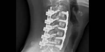 Is Chiropractic Safe After Having Neck or Back Surgery?