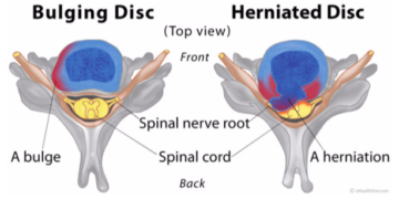 What You Need to Know about Arthritis and Spinal Disc Issues