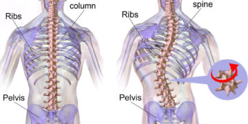 The Real Importance for Scoliosis Screening